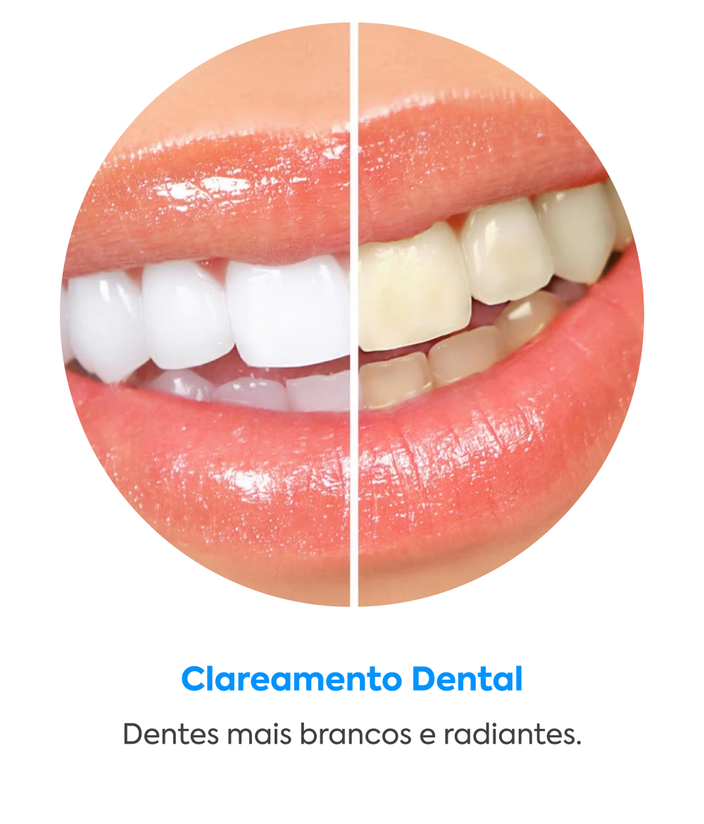 Clareamento Dental