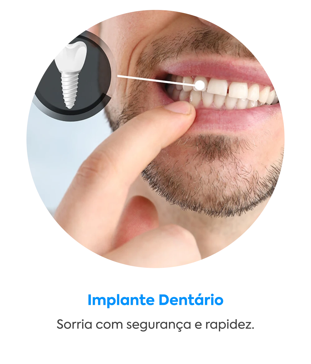 Implante Dentário